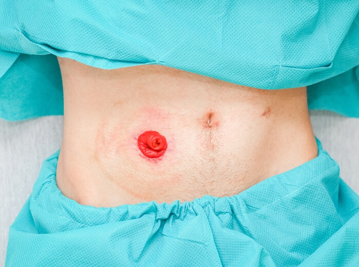 a-young-patient-in-pajamas-with-an-open-stomach-p-2025-03-06-15-02-49-utc (1) (1)