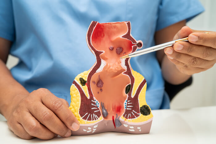 asian-doctor-with-rectum-and-hemorrhoid-human-anat-2025-03-13-19-47-39-utc (1) (1)